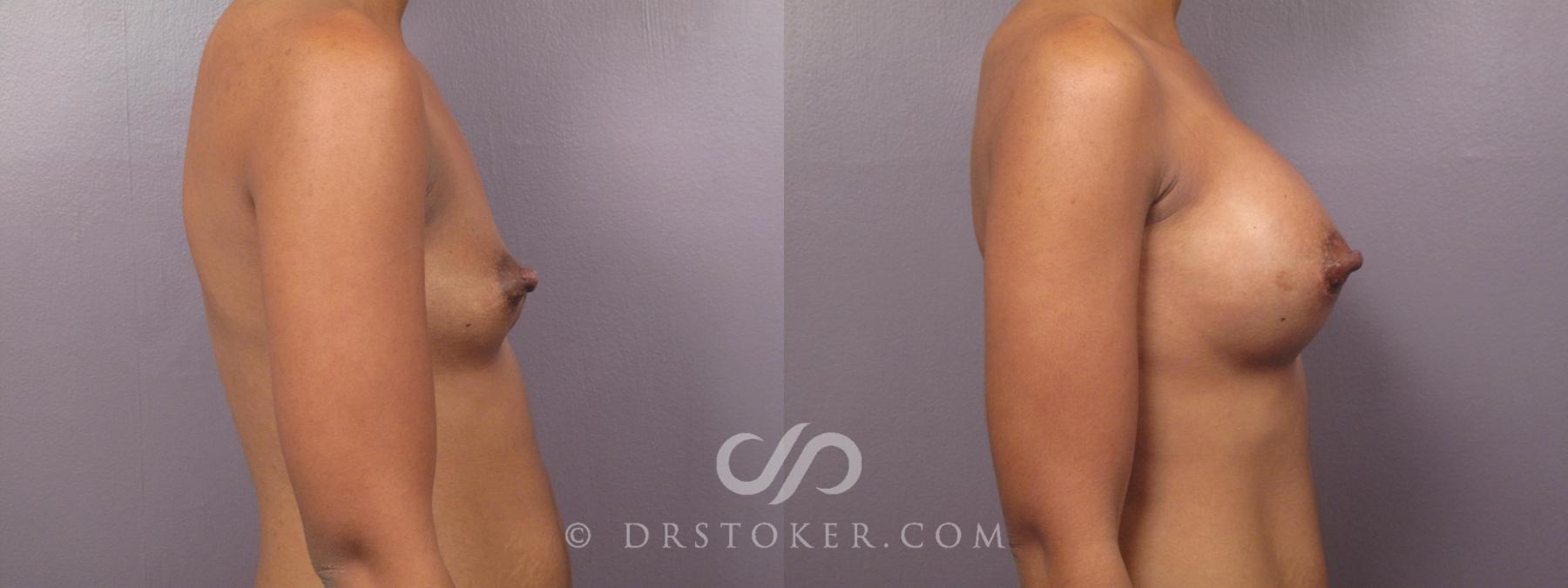Before & After Breast Augmentation, Rapid Recovery Case 384 View #2 View in Los Angeles, CA