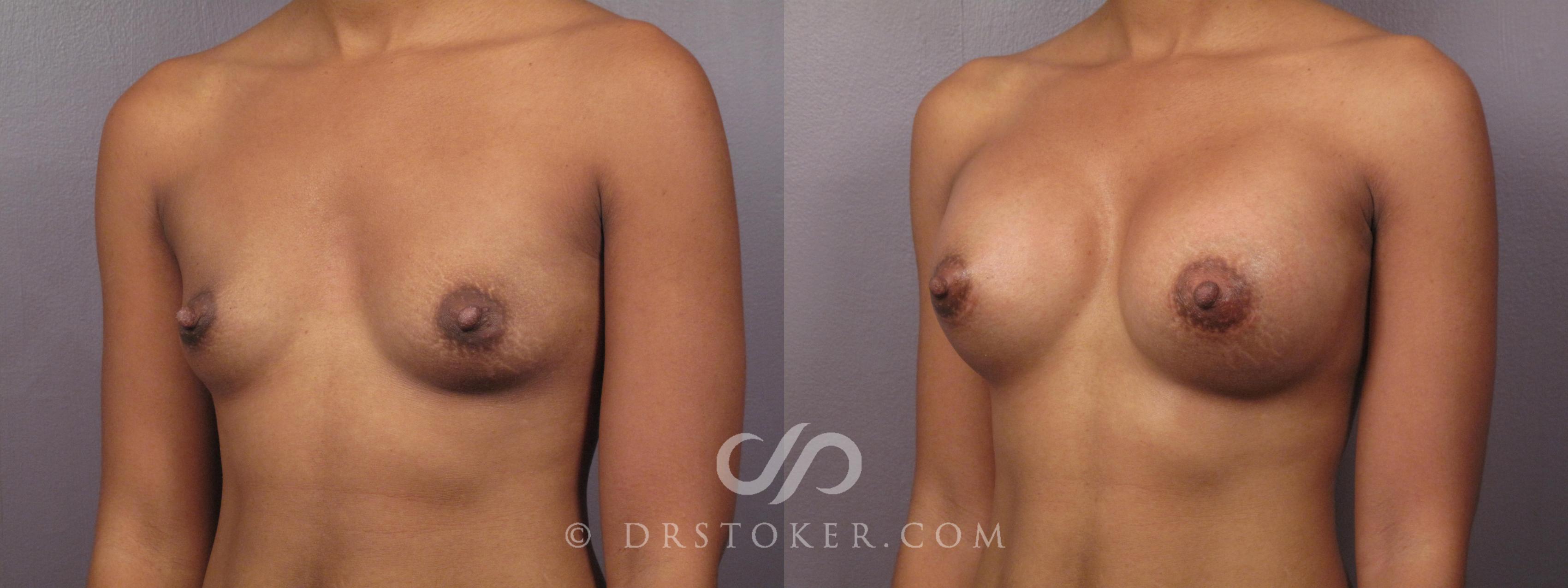 Before & After Breast Augmentation, Rapid Recovery Case 384 View #5 View in Los Angeles, CA