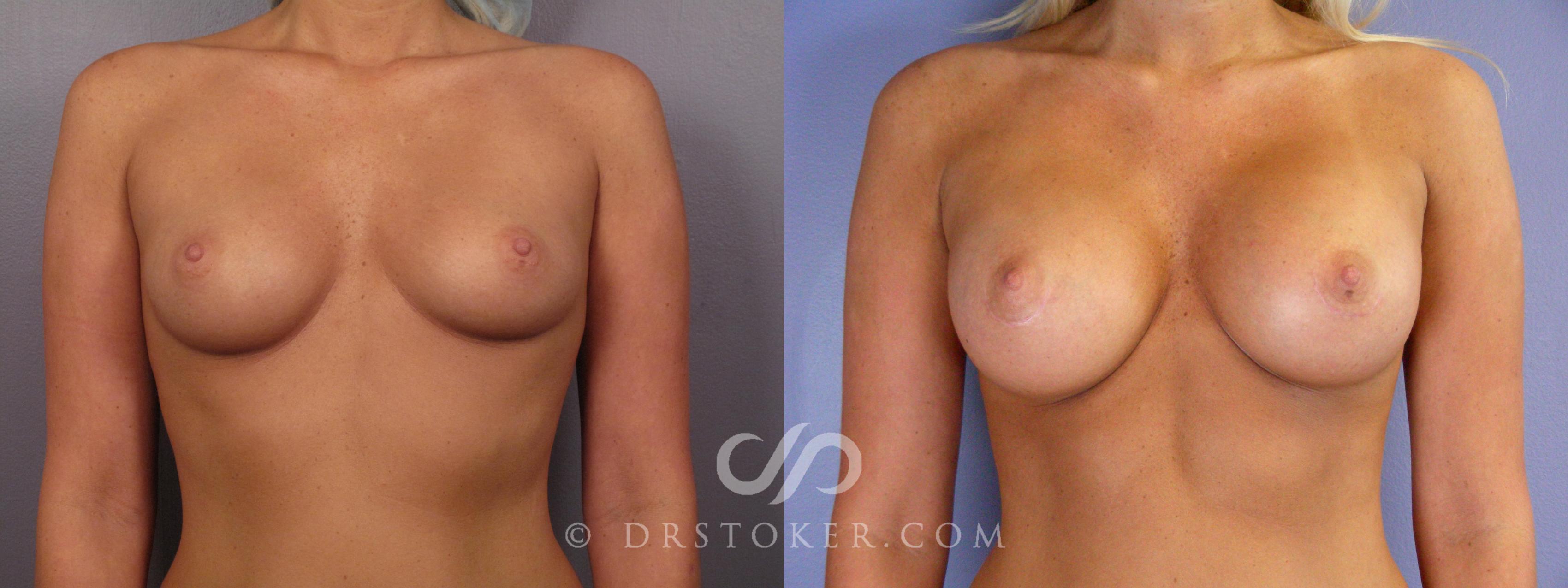 Before & After Breast Augmentation, Rapid Recovery Case 401 View #1 View in Los Angeles, CA