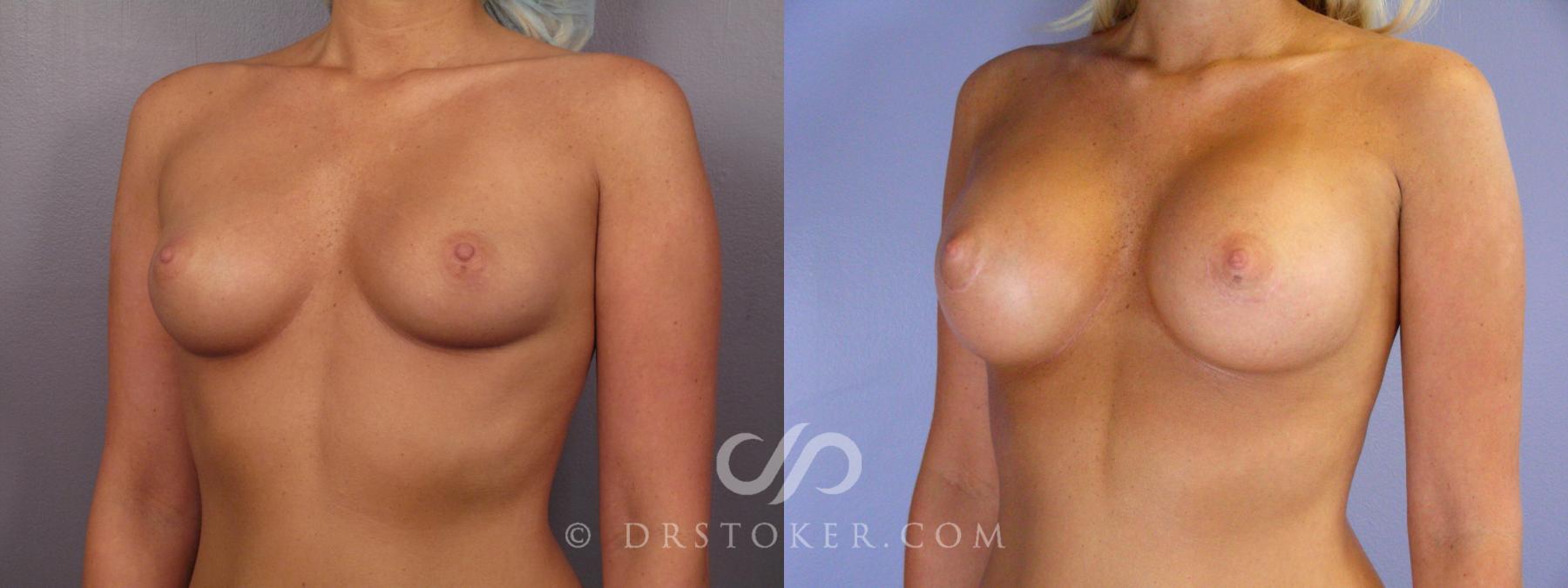 Before & After Breast Augmentation, Rapid Recovery Case 401 View #2 View in Los Angeles, CA