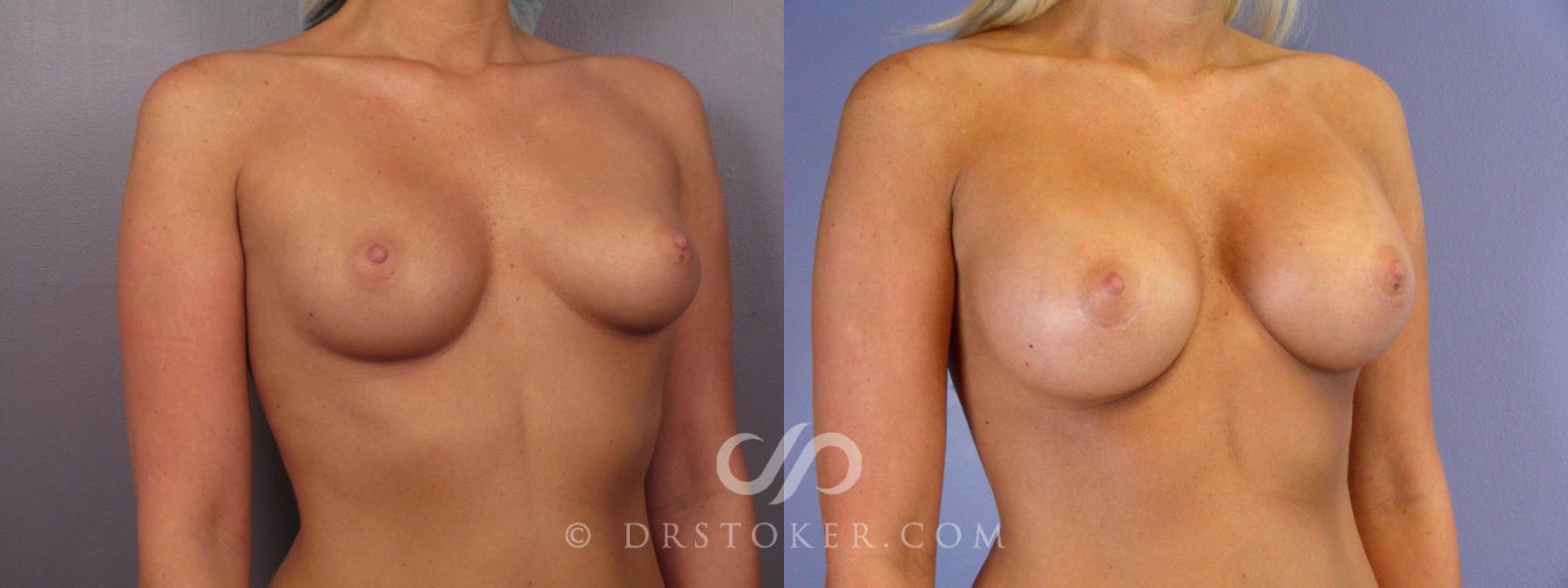Before & After Breast Augmentation, Rapid Recovery Case 401 View #3 View in Los Angeles, CA