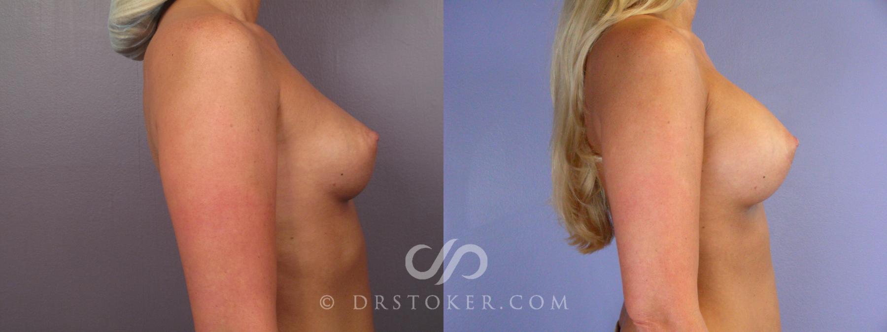 Before & After Breast Augmentation, Rapid Recovery Case 401 View #4 View in Los Angeles, CA