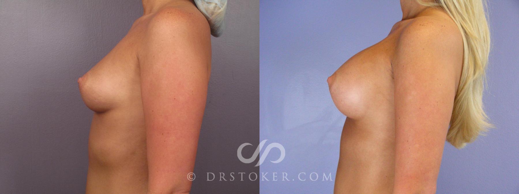 Before & After Breast Augmentation, Rapid Recovery Case 401 View #5 View in Los Angeles, CA