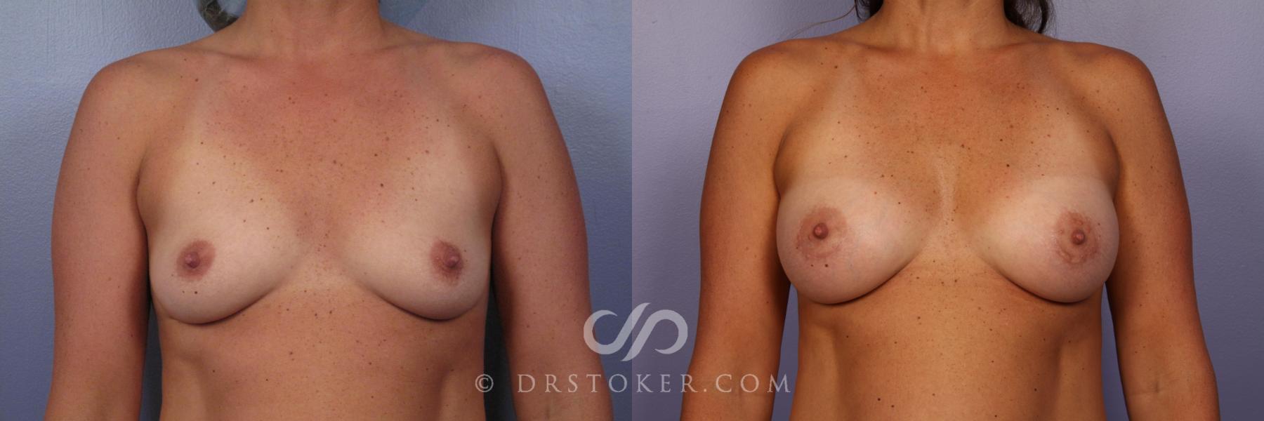Before & After Breast Augmentation, Rapid Recovery Case 402 View #1 View in Los Angeles, CA