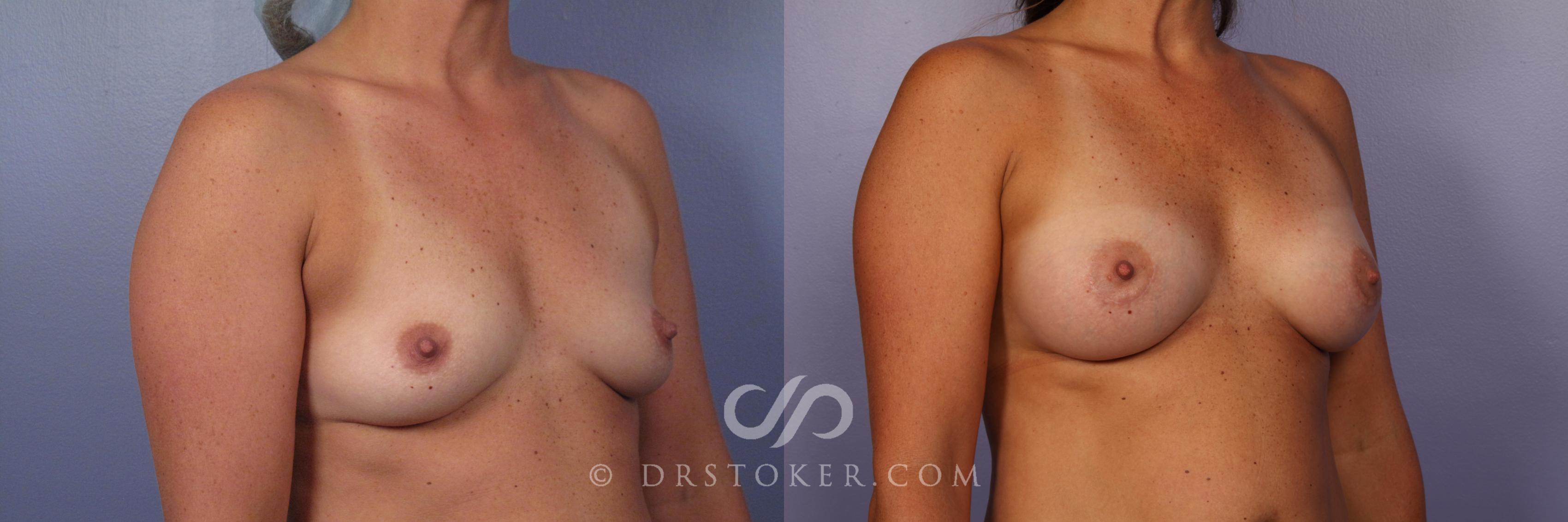 Before & After Breast Augmentation, Rapid Recovery Case 402 View #3 View in Los Angeles, CA