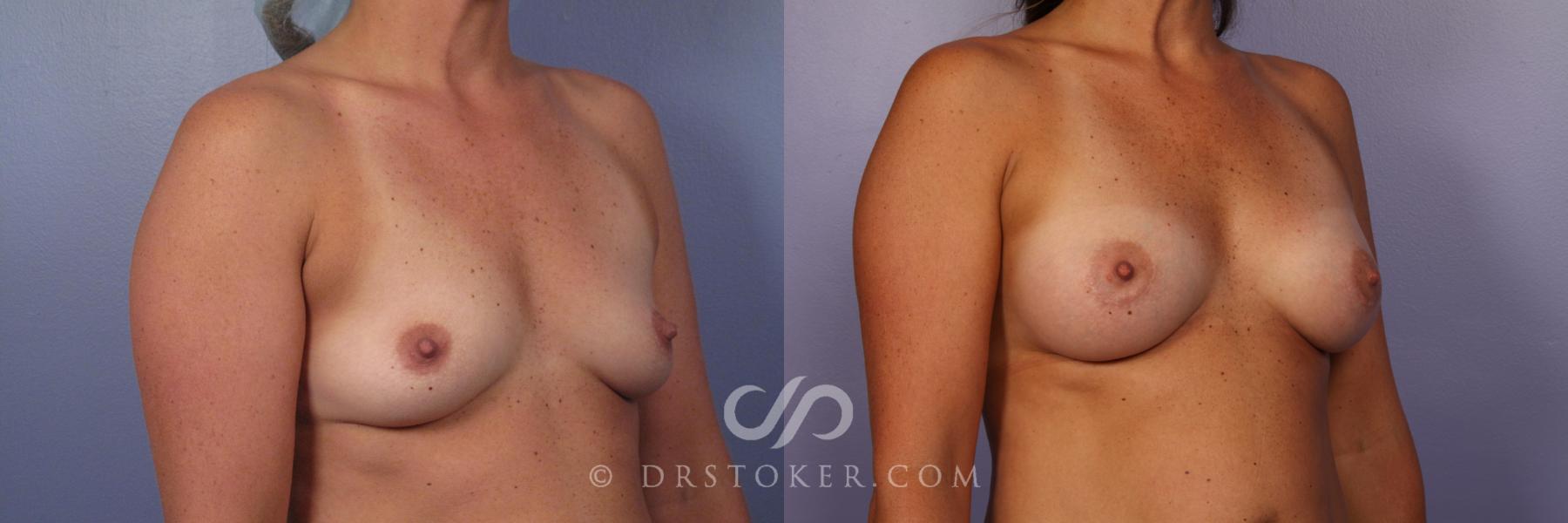 Before & After Breast Augmentation, Rapid Recovery Case 402 View #3 View in Los Angeles, CA
