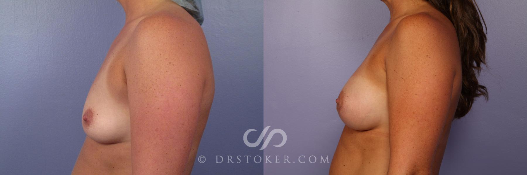Before & After Breast Augmentation, Rapid Recovery Case 402 View #5 View in Los Angeles, CA