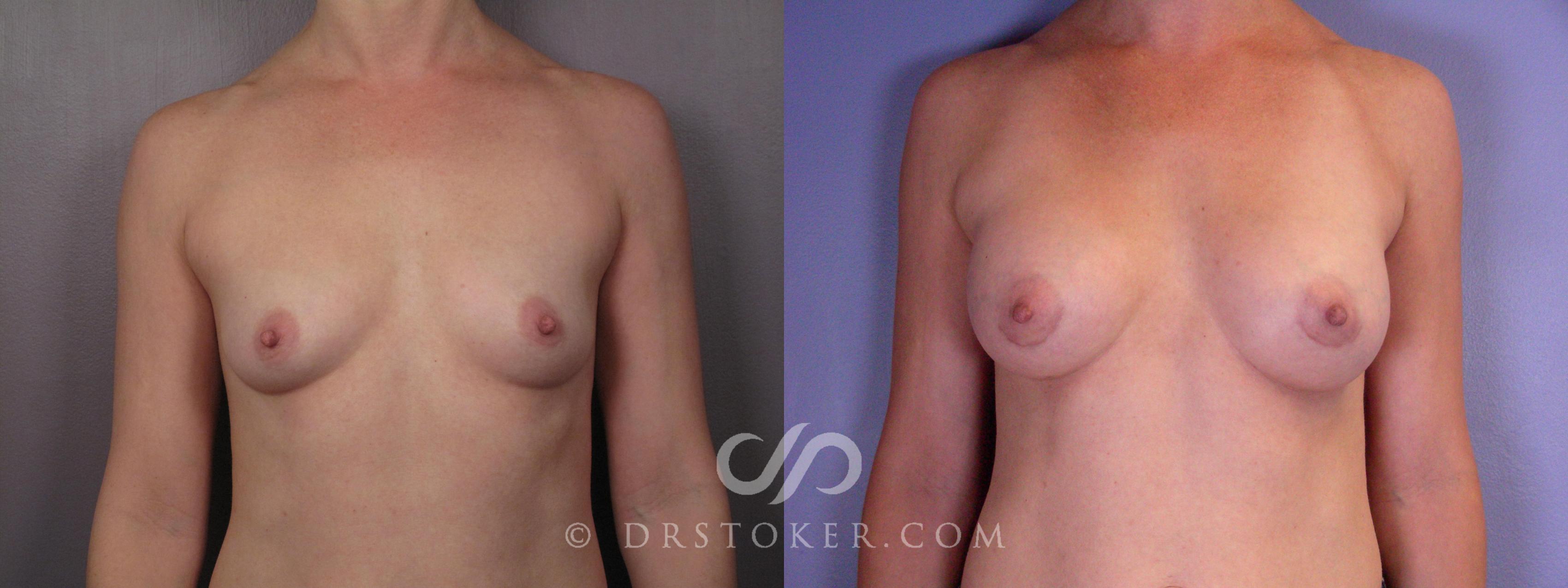 Before & After Breast Augmentation, Rapid Recovery Case 403 View #1 View in Los Angeles, CA