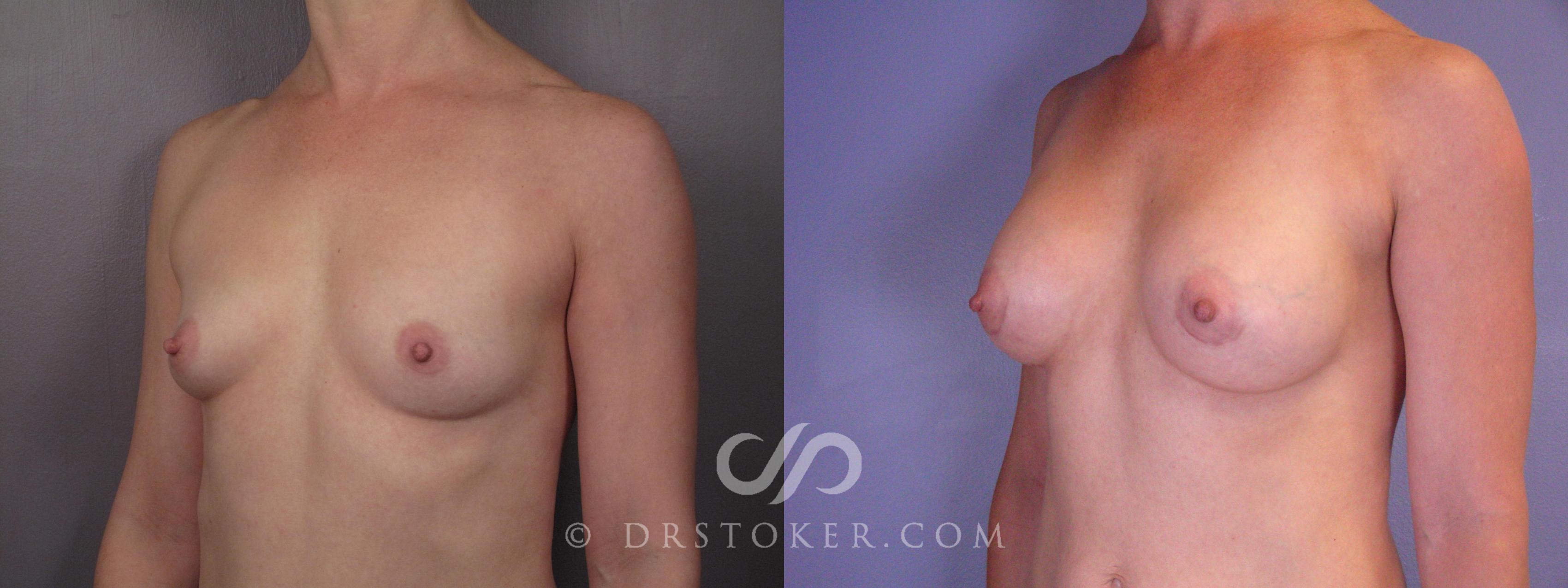 Before & After Breast Augmentation, Rapid Recovery Case 403 View #2 View in Los Angeles, CA