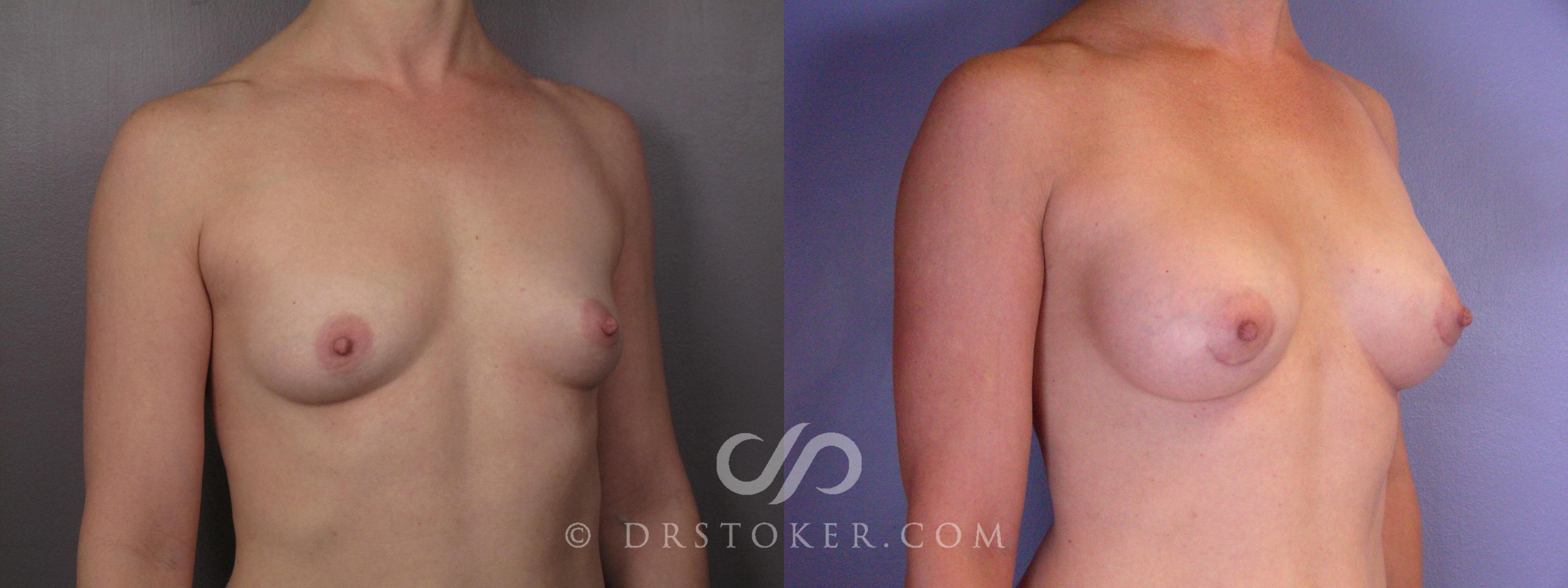 Before & After Breast Augmentation, Rapid Recovery Case 403 View #3 View in Los Angeles, CA