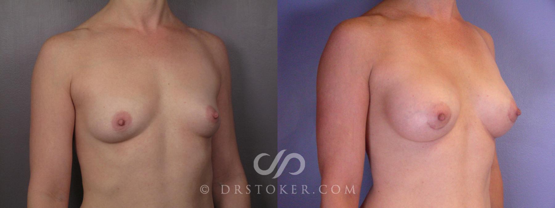 Before & After Breast Augmentation, Rapid Recovery Case 403 View #3 View in Los Angeles, CA