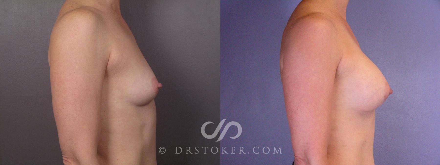 Before & After Breast Augmentation, Rapid Recovery Case 403 View #4 View in Los Angeles, CA