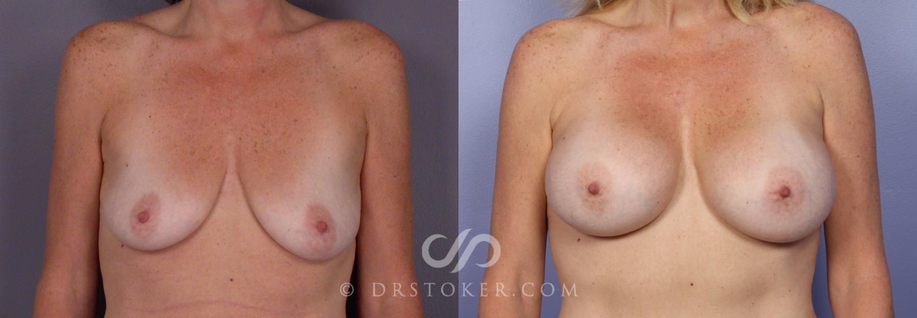 Before & After Breast Augmentation, Rapid Recovery Case 408 View #1 View in Los Angeles, CA