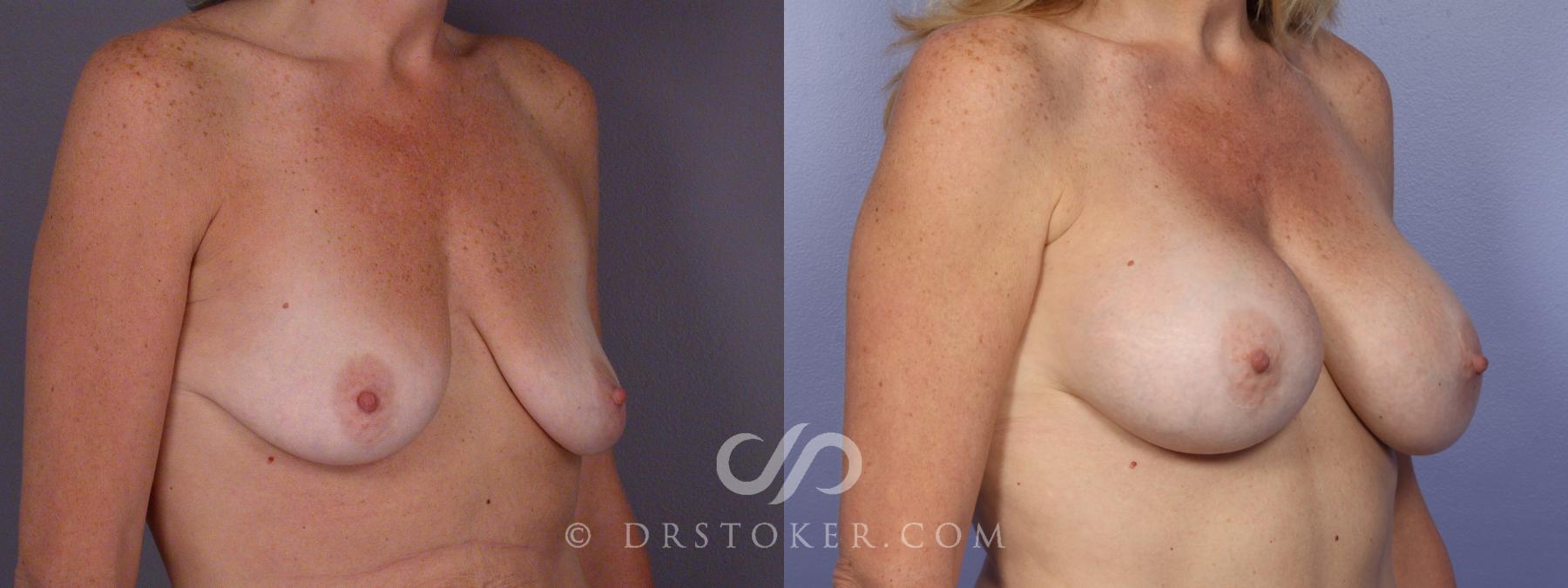 Before & After Breast Augmentation, Rapid Recovery Case 408 View #2 View in Los Angeles, CA