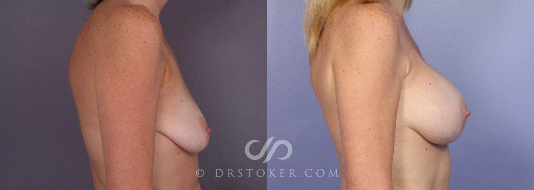 Before & After Breast Augmentation, Rapid Recovery Case 408 View #3 View in Los Angeles, CA