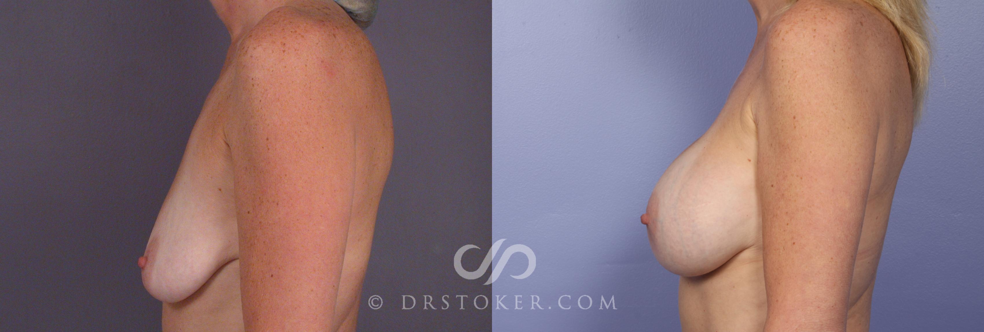 Before & After Breast Augmentation, Rapid Recovery Case 408 View #4 View in Los Angeles, CA