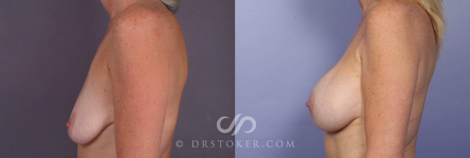 Before & After Breast Augmentation, Rapid Recovery Case 408 View #4 View in Los Angeles, CA