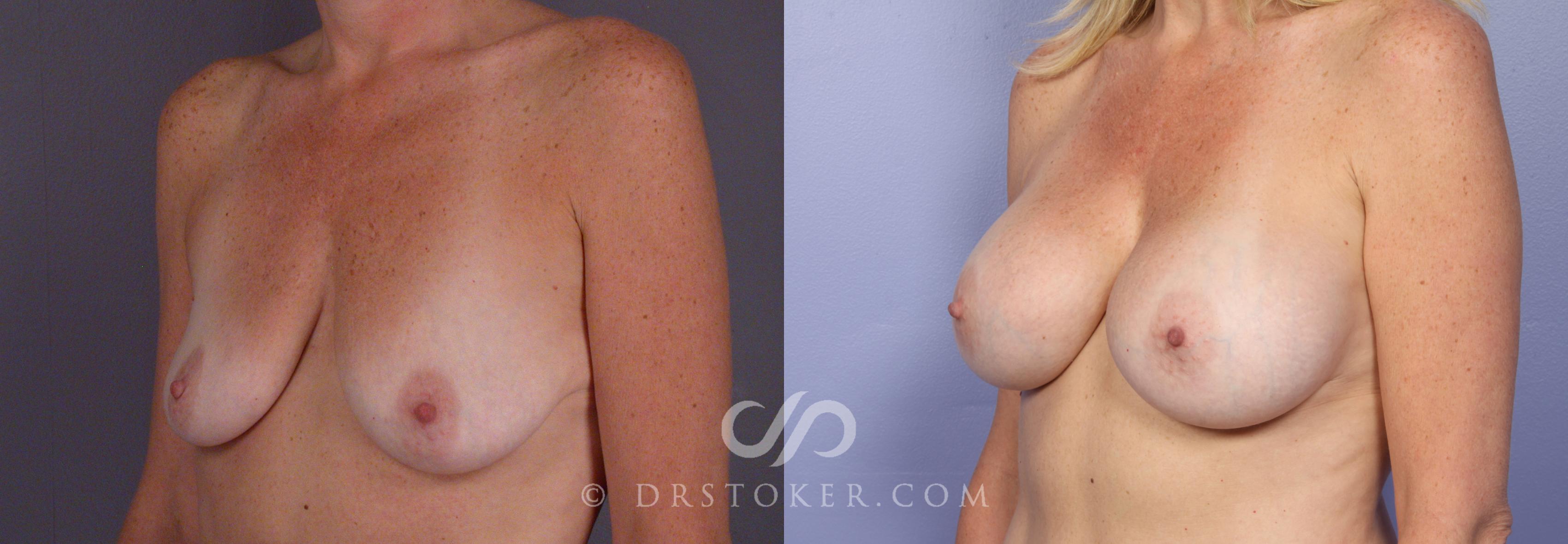 Before & After Breast Augmentation, Rapid Recovery Case 408 View #5 View in Los Angeles, CA