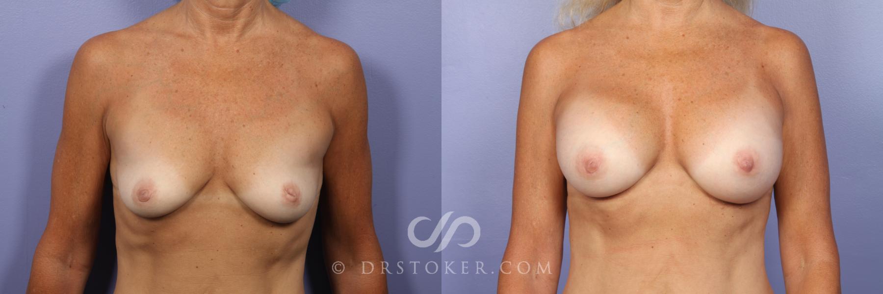 Before & After Breast Augmentation, Rapid Recovery Case 444 View #1 View in Los Angeles, CA