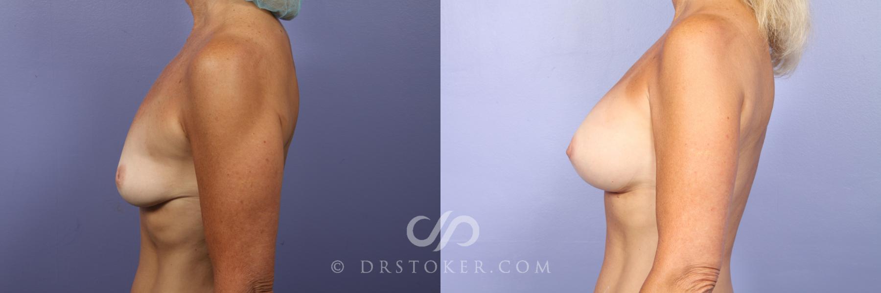 Before & After Breast Augmentation, Rapid Recovery Case 444 View #3 View in Los Angeles, CA
