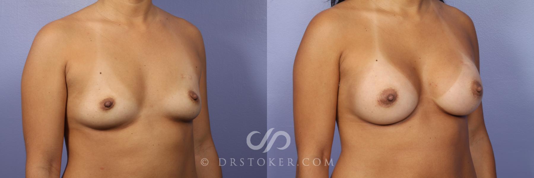 Before & After Breast Augmentation, Rapid Recovery Case 445 View #2 View in Los Angeles, CA