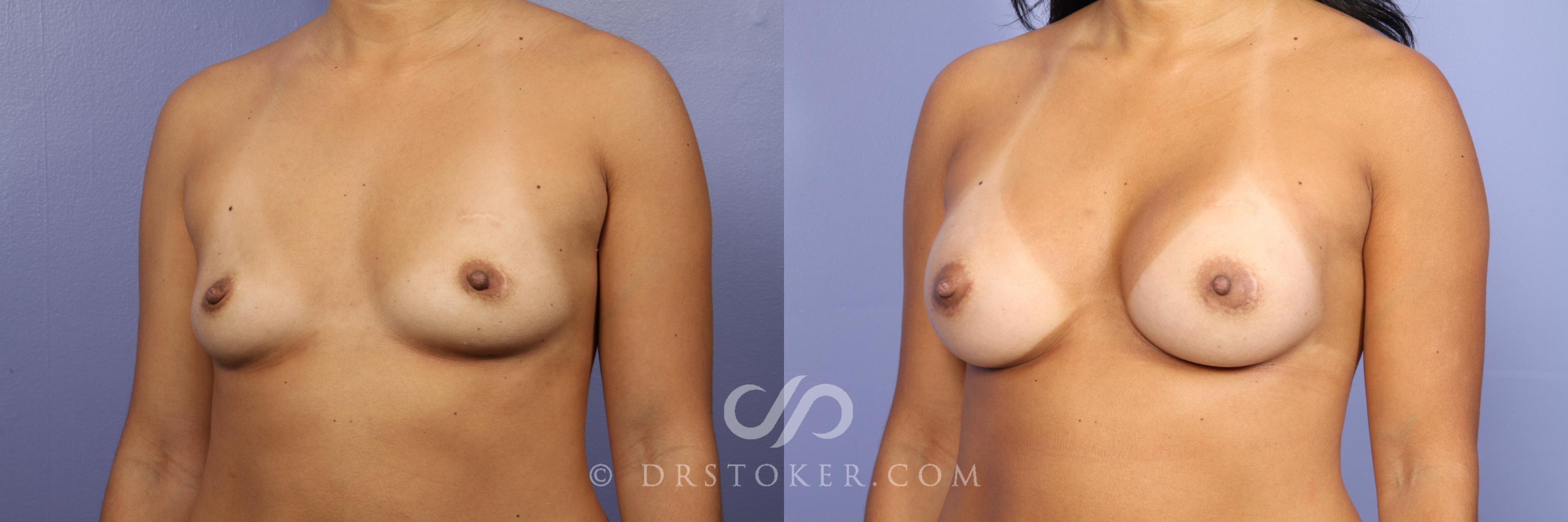 Before & After Breast Augmentation, Rapid Recovery Case 445 View #4 View in Los Angeles, CA