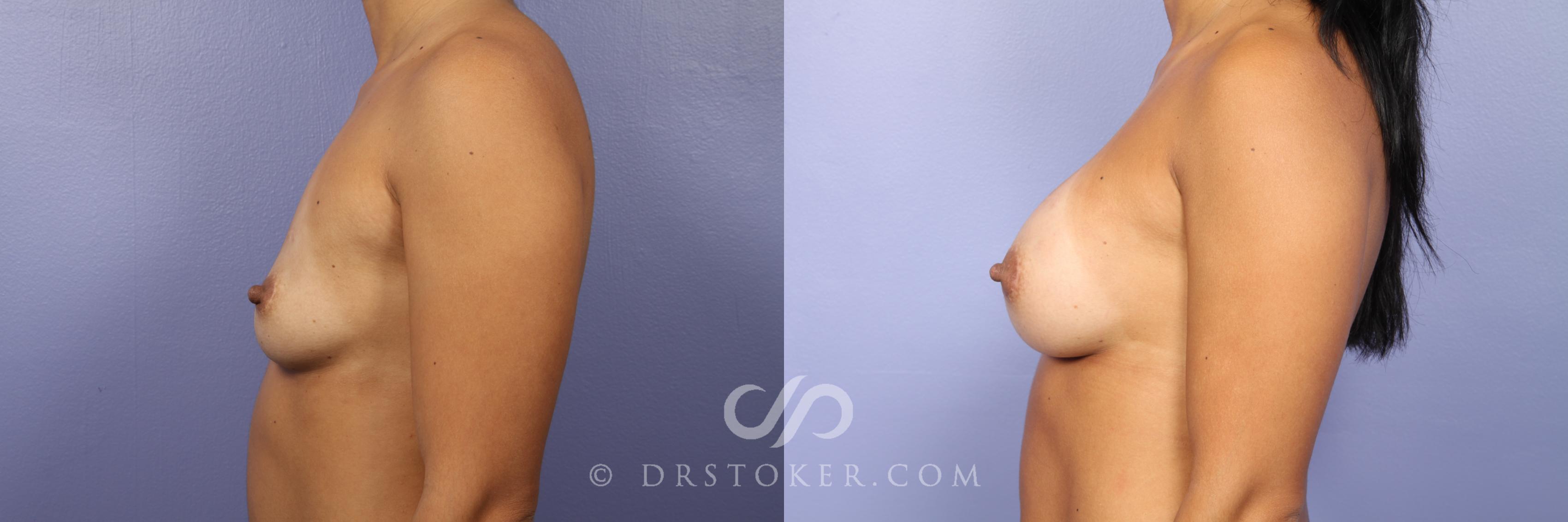 Before & After Breast Augmentation, Rapid Recovery Case 445 View #5 View in Los Angeles, CA