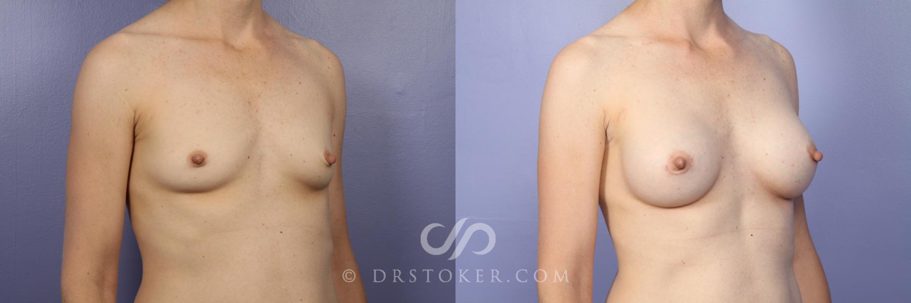 Before & After Breast Augmentation, Rapid Recovery Case 446 View #2 View in Los Angeles, CA