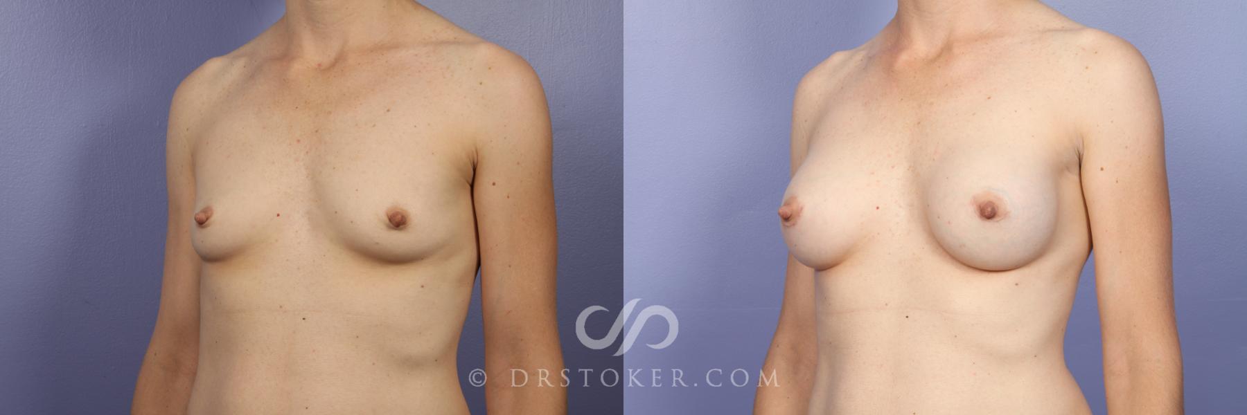 Before & After Breast Augmentation, Rapid Recovery Case 446 View #4 View in Los Angeles, CA