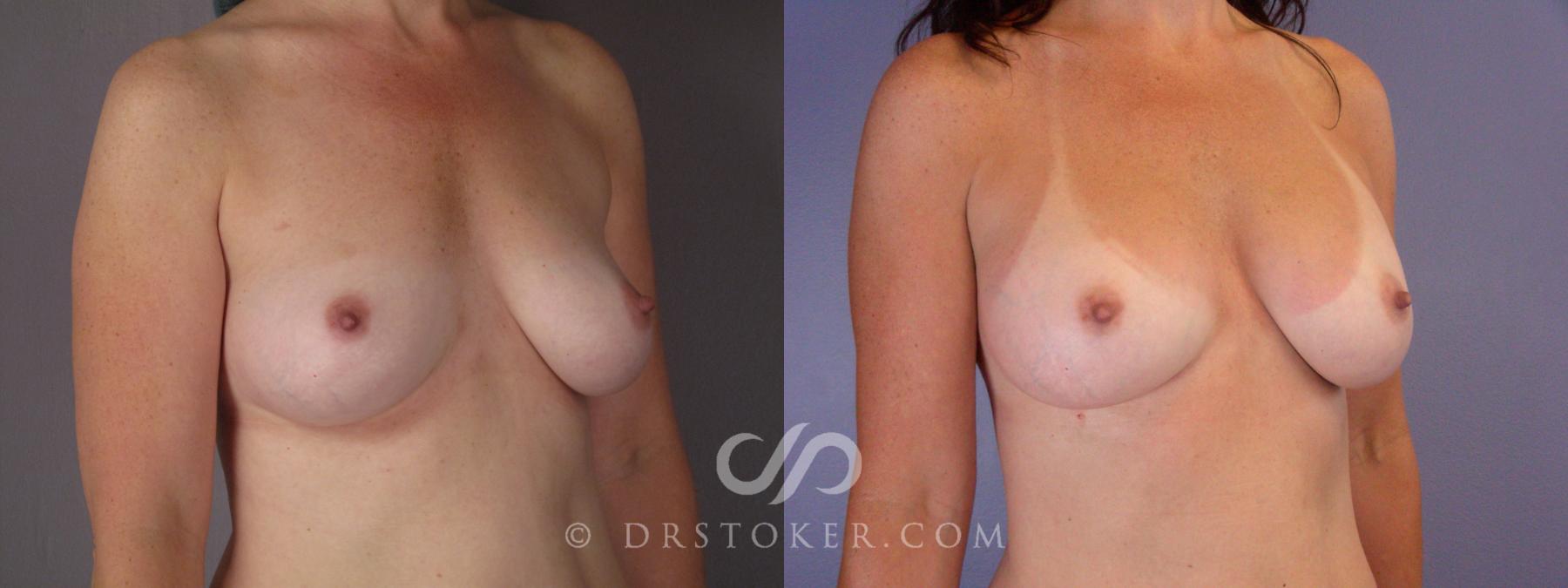 Before & After Breast Augmentation, Rapid Recovery Case 447 View #2 View in Los Angeles, CA