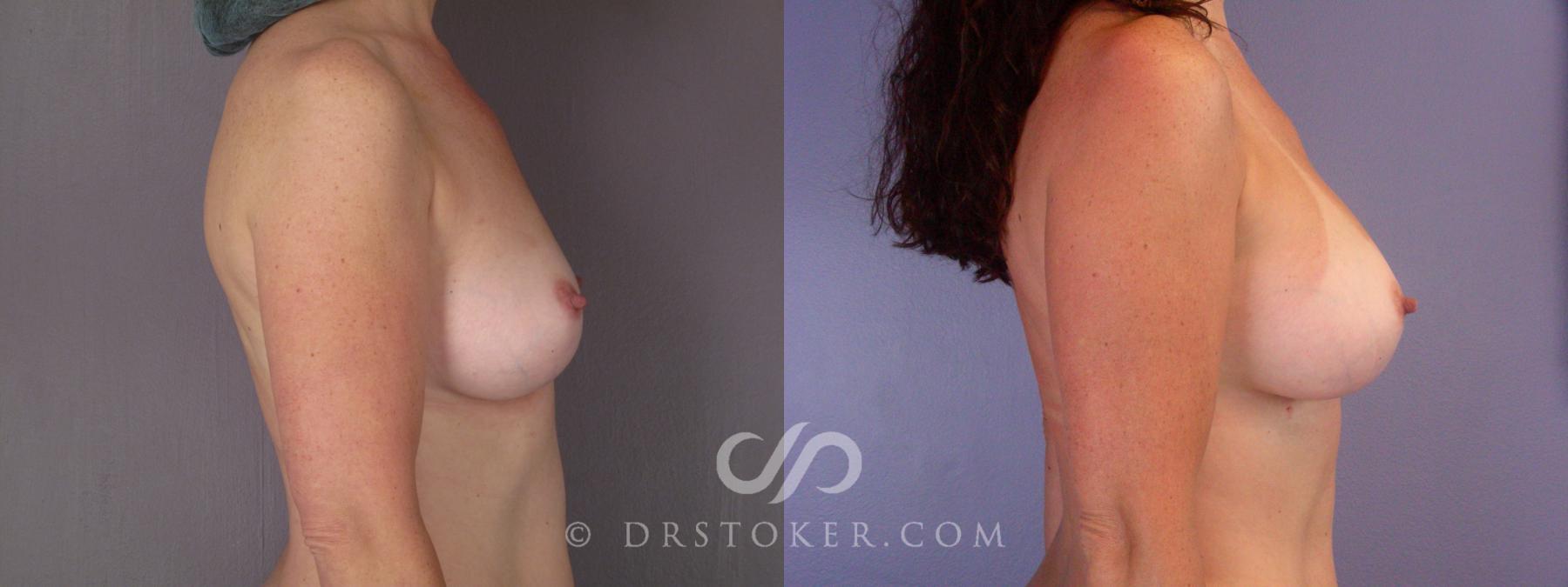 Before & After Breast Augmentation, Rapid Recovery Case 447 View #3 View in Los Angeles, CA
