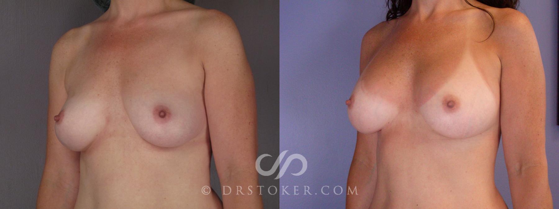 Before & After Breast Augmentation, Rapid Recovery Case 447 View #4 View in Los Angeles, CA