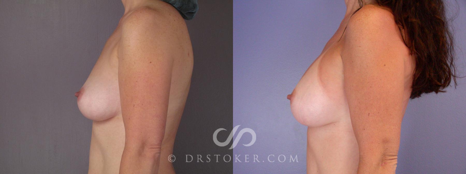 Before & After Breast Augmentation, Rapid Recovery Case 447 View #5 View in Los Angeles, CA