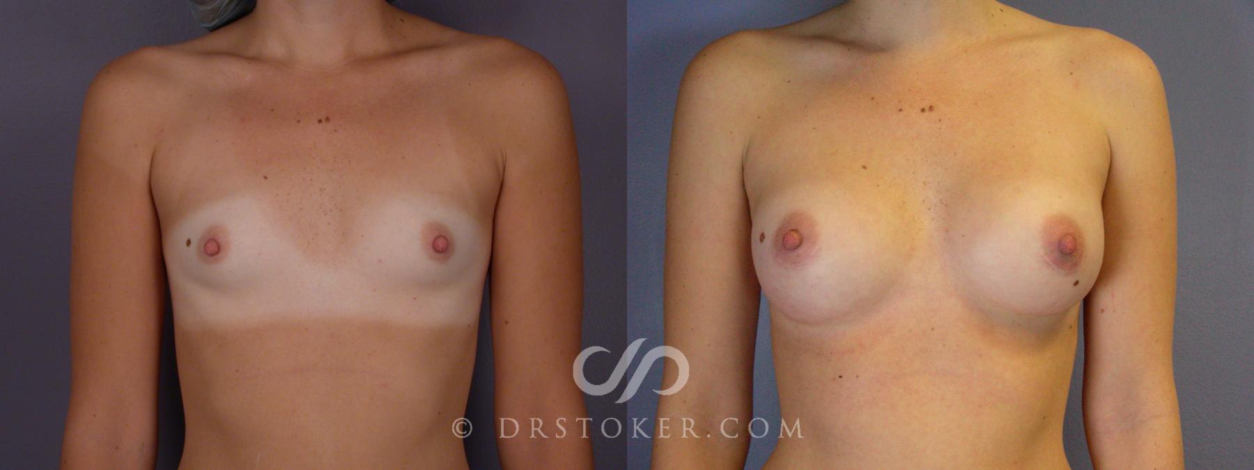 Before & After Breast Augmentation, Rapid Recovery Case 448 View #1 View in Los Angeles, CA