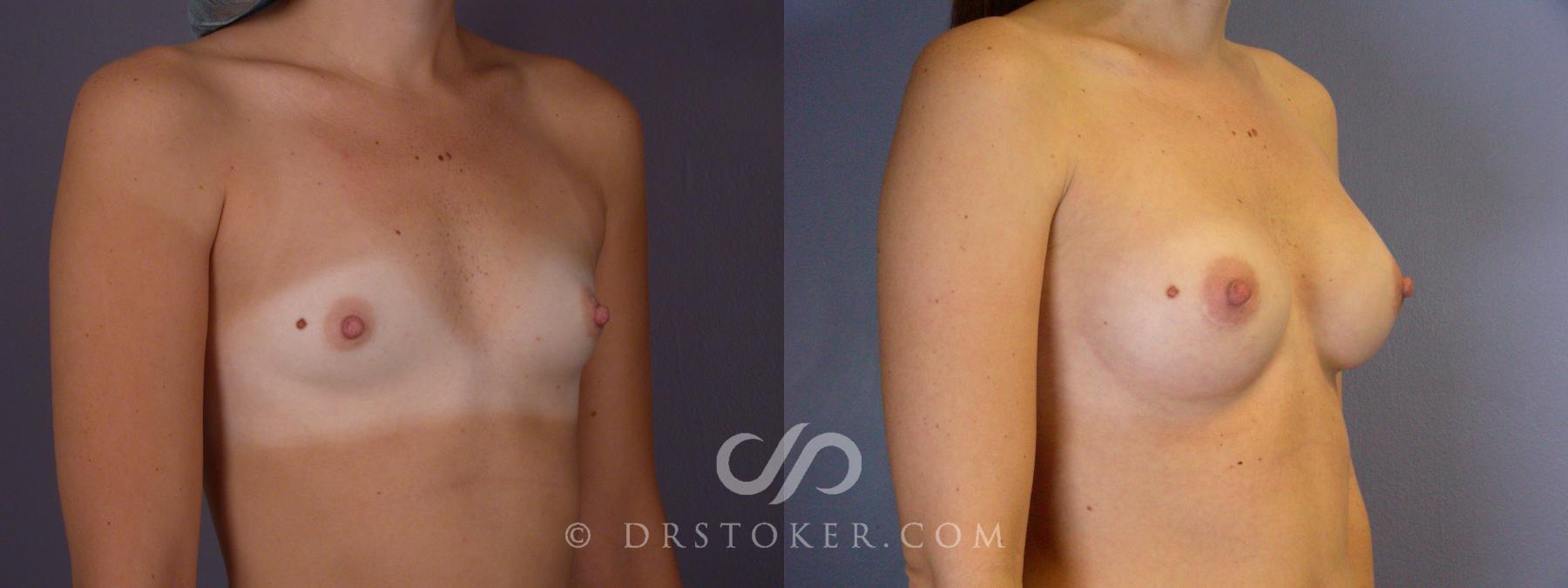 Before & After Breast Augmentation, Rapid Recovery Case 448 View #2 View in Los Angeles, CA