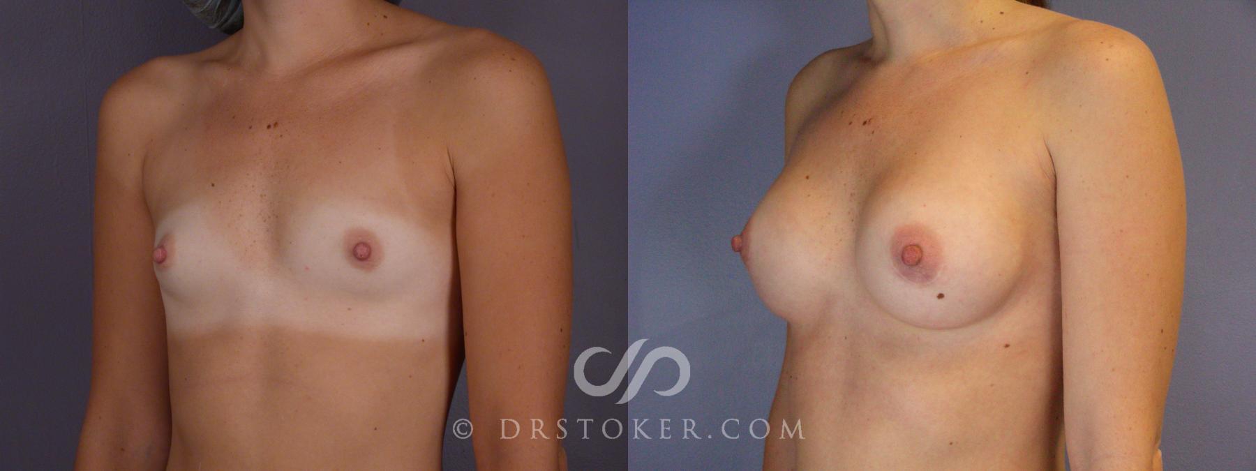 Before & After Breast Augmentation, Rapid Recovery Case 448 View #4 View in Los Angeles, CA