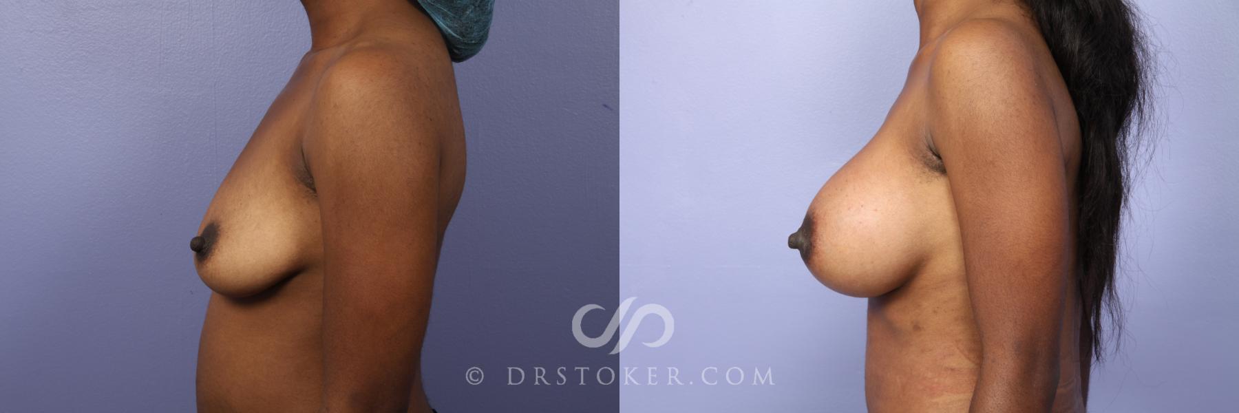 Before & After Breast Asymmetry Correction Case 450 View #3 View in Los Angeles, CA