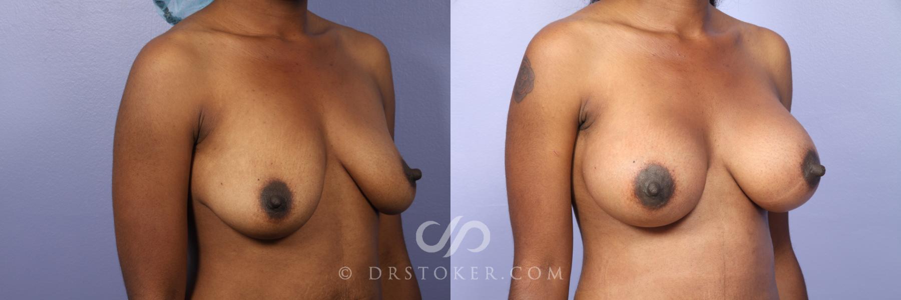 Before & After Breast Asymmetry Correction Case 450 View #4 View in Los Angeles, CA