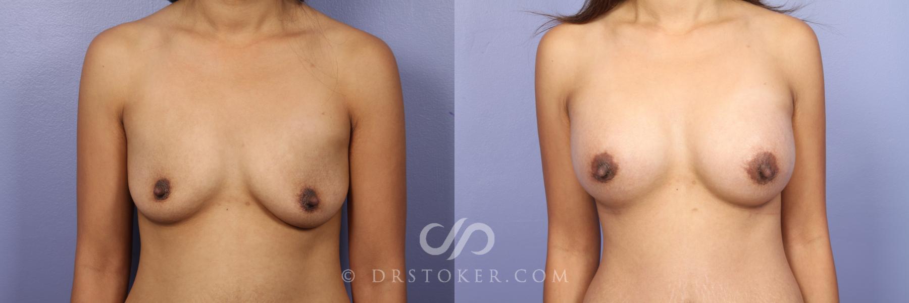 Before & After Breast Augmentation, Rapid Recovery Case 451 View #1 View in Los Angeles, CA