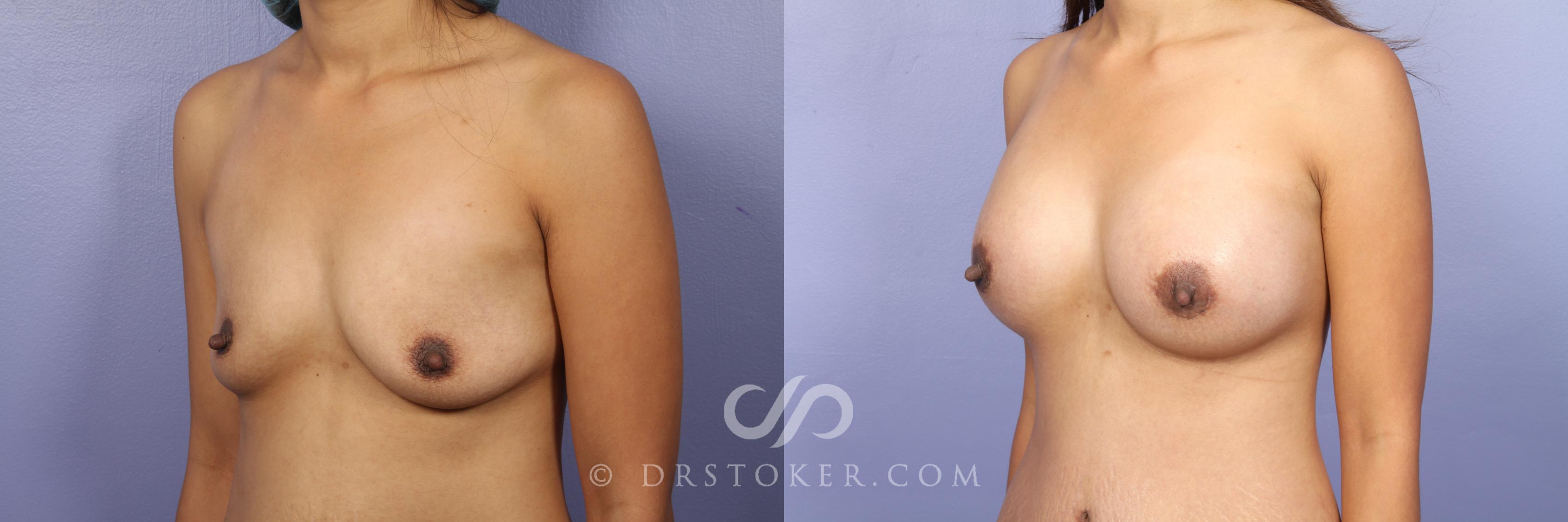 Before & After Breast Augmentation, Rapid Recovery Case 451 View #3 View in Los Angeles, CA