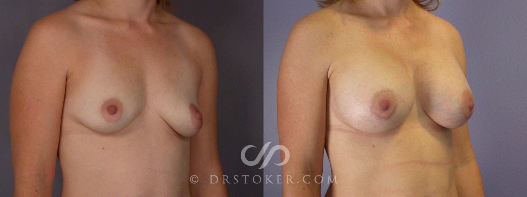 Before & After Breast Asymmetry Correction Case 452 View #2 View in Los Angeles, CA
