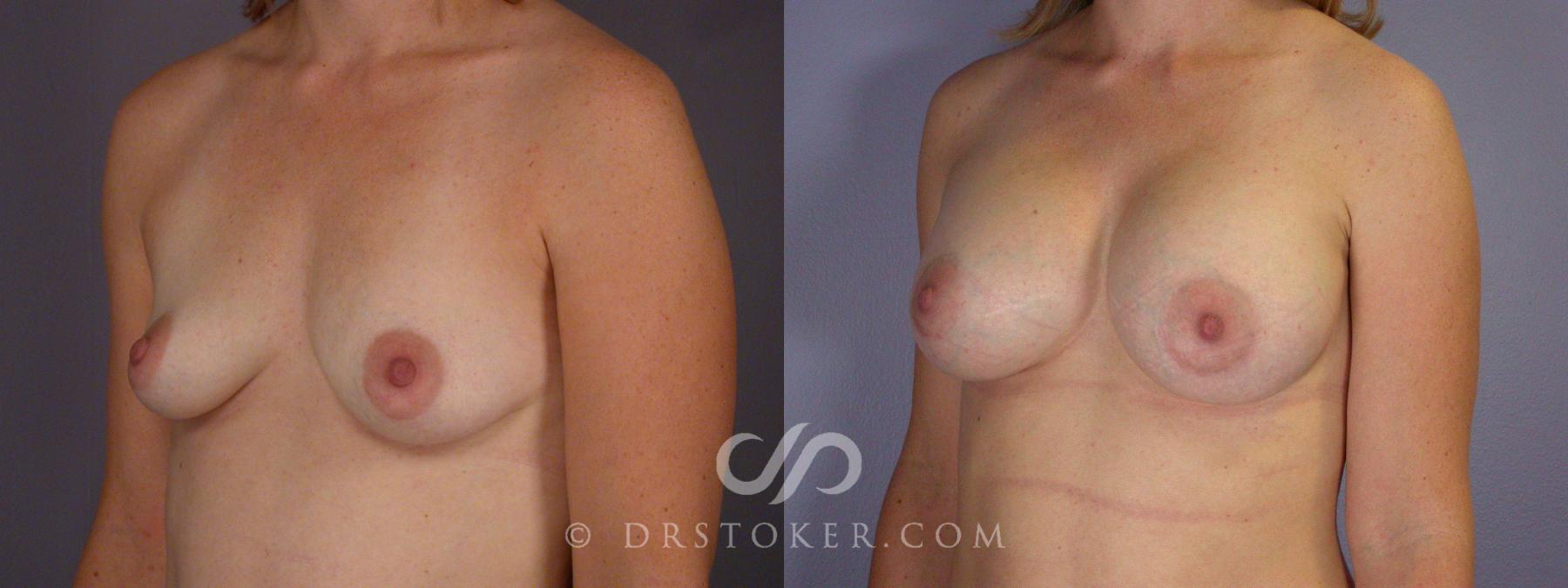 Before & After Breast Asymmetry Correction Case 452 View #4 View in Los Angeles, CA