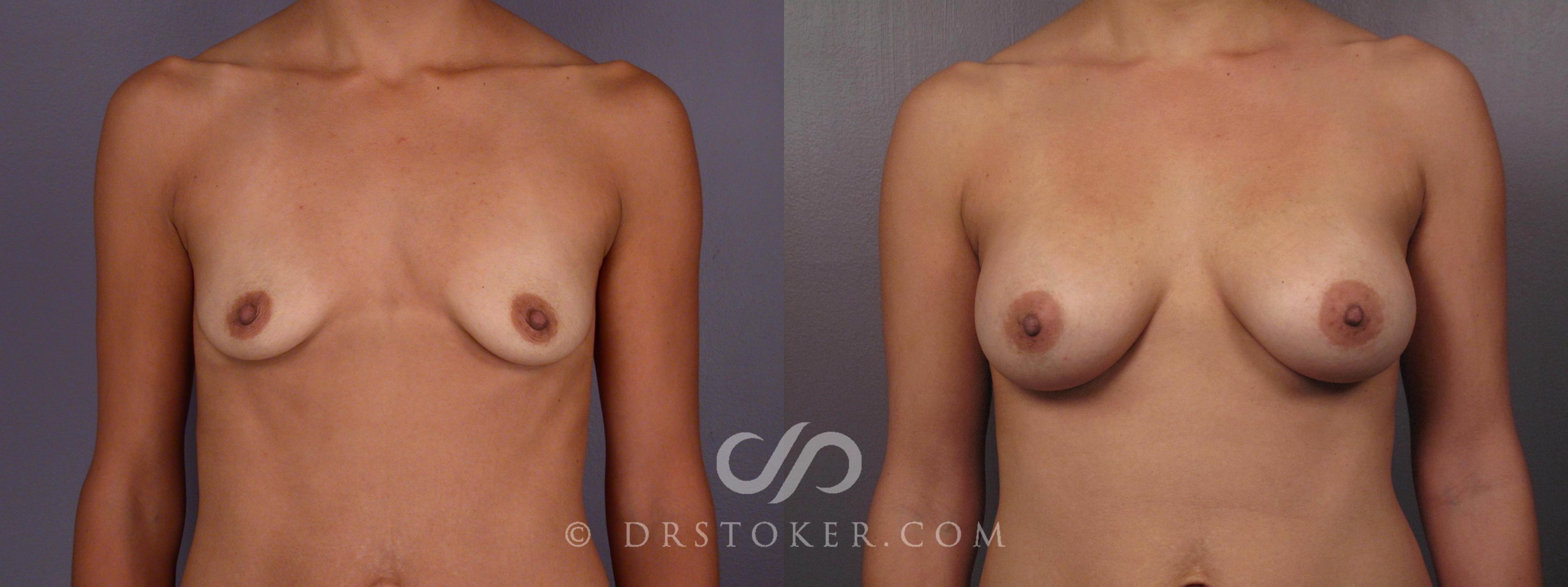 Before & After Breast Augmentation, Rapid Recovery Case 466 View #1 View in Los Angeles, CA