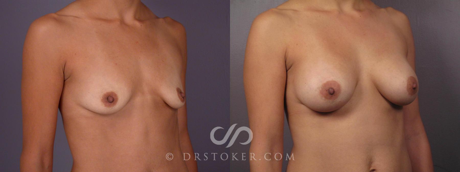 Before & After Breast Augmentation, Rapid Recovery Case 466 View #2 View in Los Angeles, CA