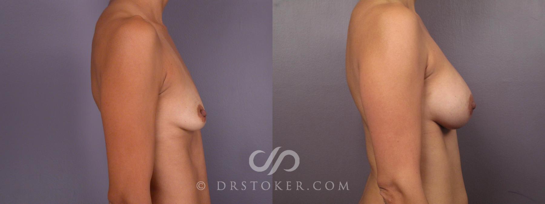 Before & After Breast Augmentation, Rapid Recovery Case 466 View #3 View in Los Angeles, CA