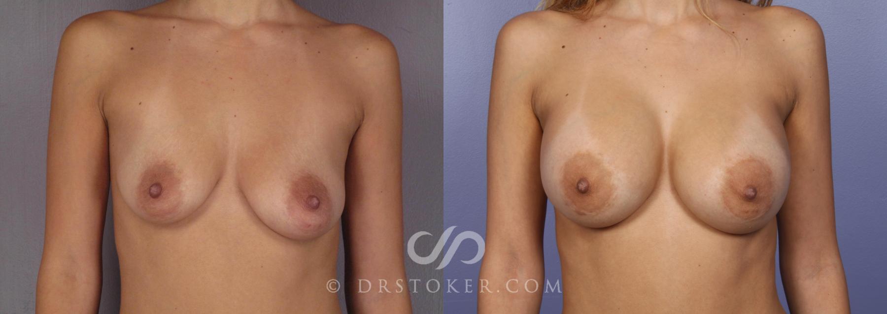 Before & After Breast Augmentation, Rapid Recovery Case 471 View #1 View in Los Angeles, CA