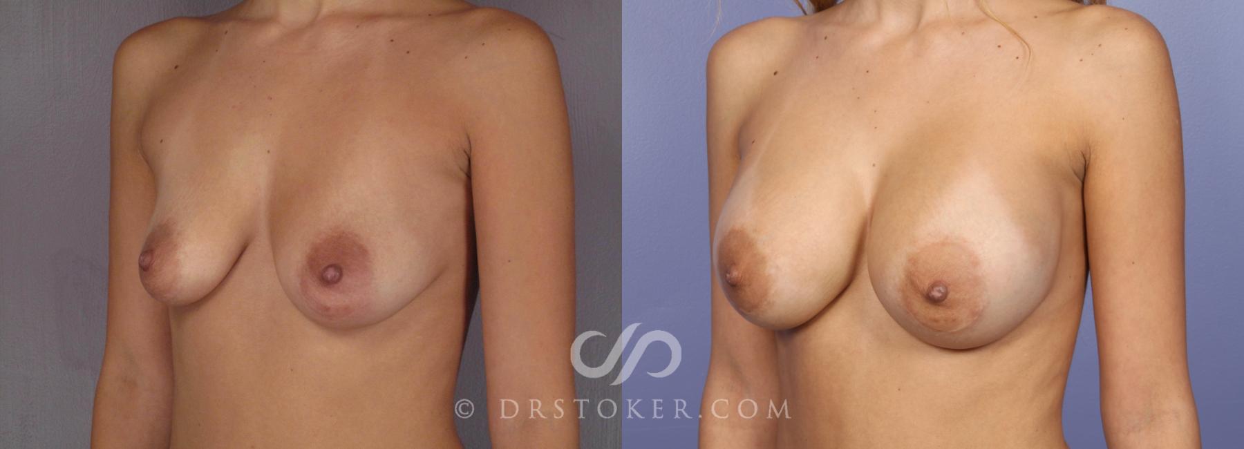 Before & After Breast Augmentation, Rapid Recovery Case 471 View #2 View in Los Angeles, CA