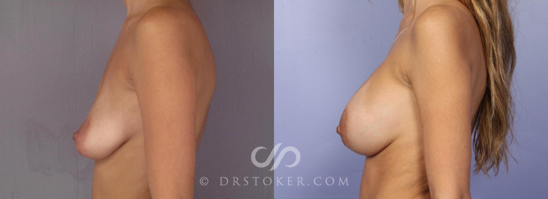 Before & After Breast Augmentation, Rapid Recovery Case 471 View #3 View in Los Angeles, CA