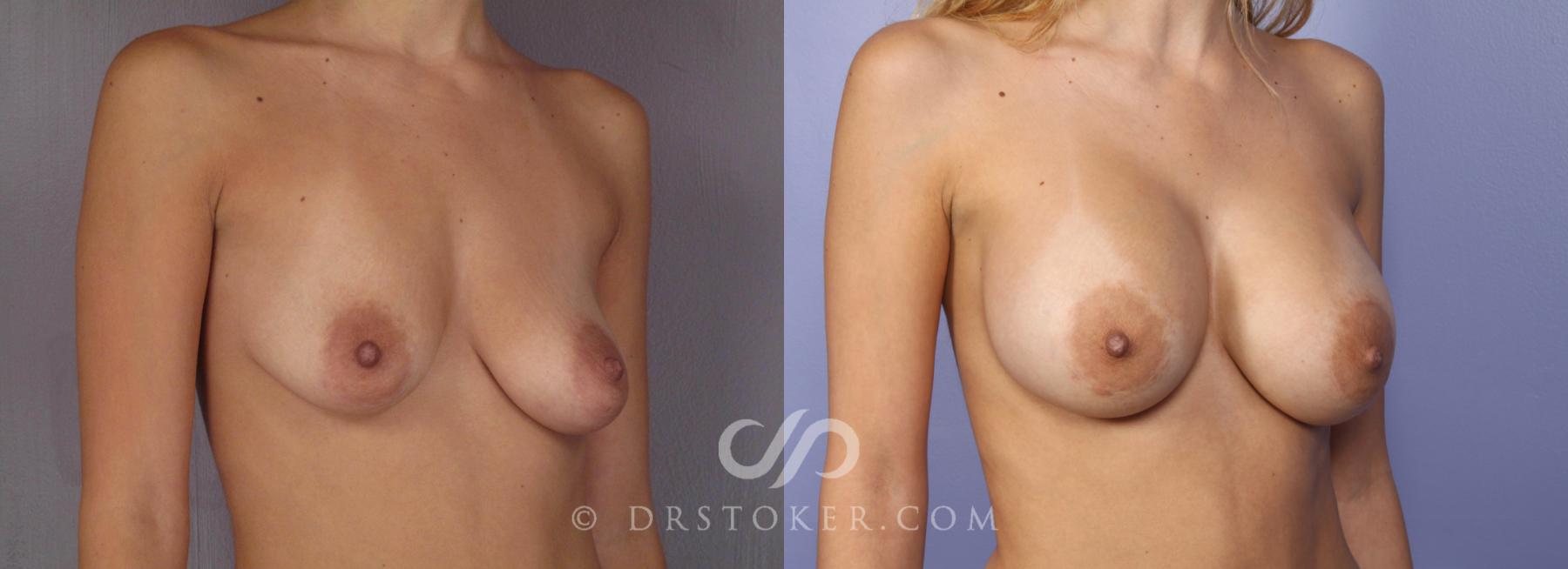 Before & After Breast Asymmetry Correction Case 471 View #4 View in Los Angeles, CA