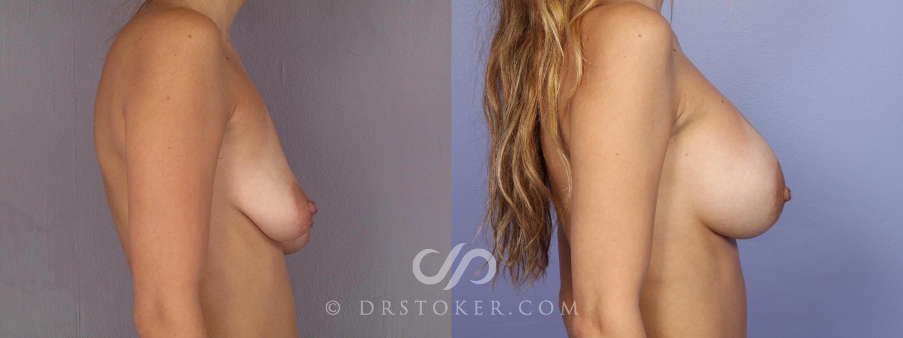 Before & After Breast Asymmetry Correction Case 471 View #5 View in Los Angeles, CA